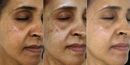 Corrector de Manchas Oscuras by Orelvie