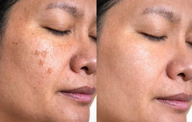 Corrector de Manchas Oscuras by Orelvie