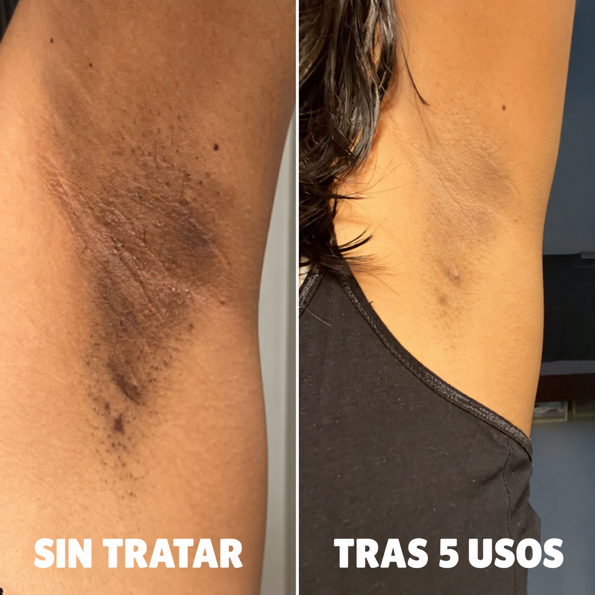 Complejo de triple ácido para la hiperpigmentación by Orelvie