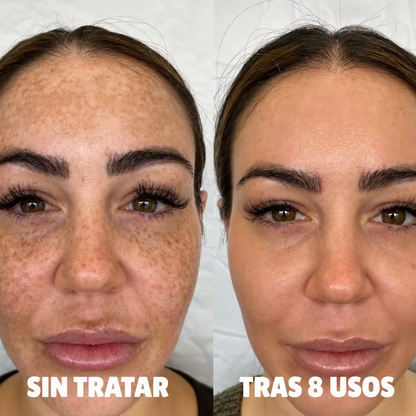 Complejo de triple ácido para la hiperpigmentación by Orelvie