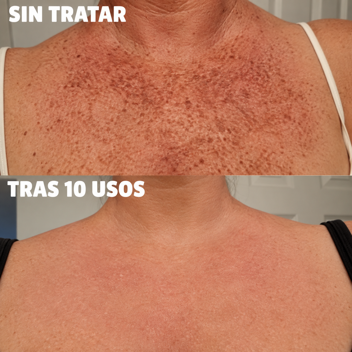 Complejo de triple ácido para la hiperpigmentación by Orelvie