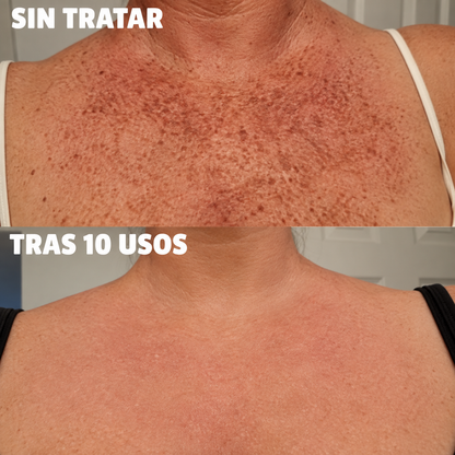 Complejo de triple ácido para la hiperpigmentación by Orelvie