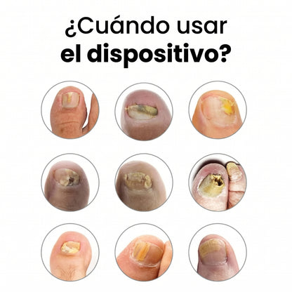 OrthoNails: Reparador Antifúngico Laser by Orelvie