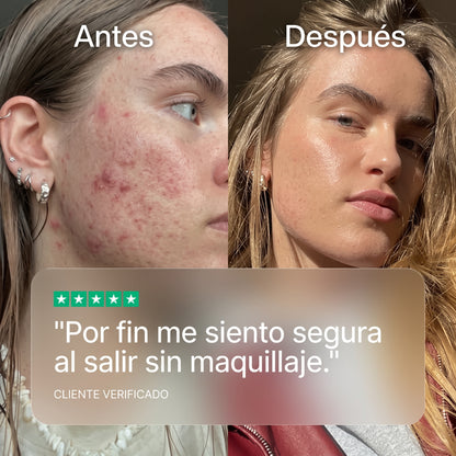 Claro+ Acné by Orelvie