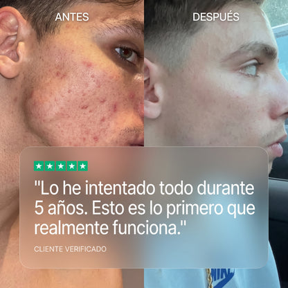 Claro+ Acné by Orelvie